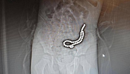 整整37颗!云南4岁孩子身体里取出……医生紧急提醒!